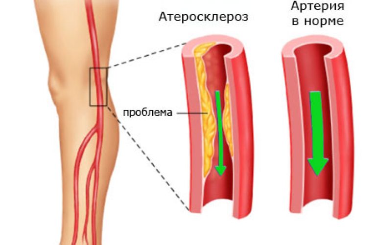 Заболевания артерий вен