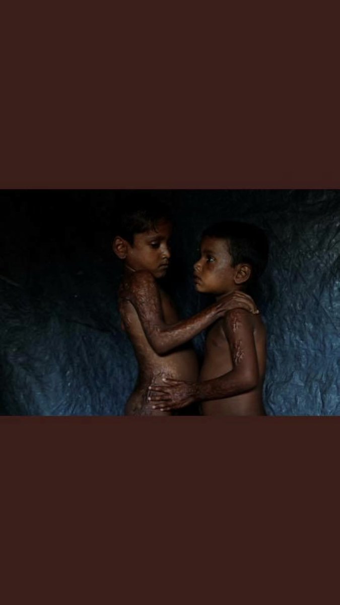 As_Alsharaa's tweet photo. Children with burns and scars from machete wounds and bullets. The violence against #Rohingya Muslims must end!! #UN #ENICEF #Save ChildrenOfROhingya https://t.co/GDAgxRoCaC