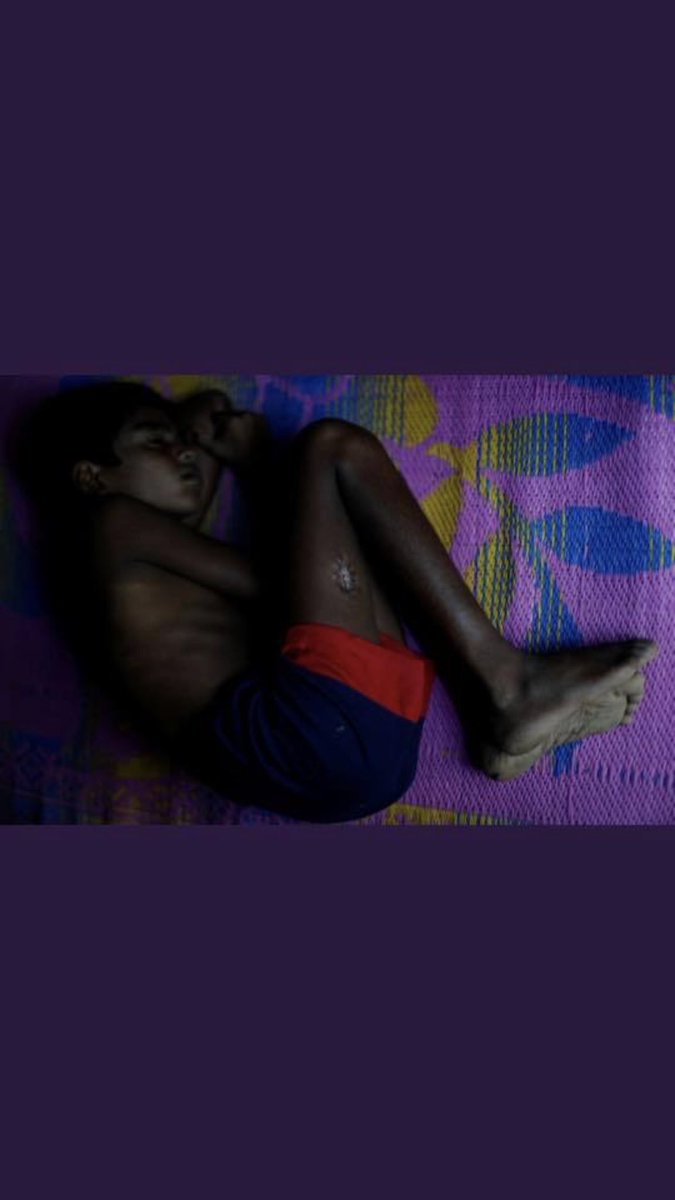 As_Alsharaa's tweet photo. Children with burns and scars from machete wounds and bullets. The violence against #Rohingya Muslims must end!! #UN #ENICEF #Save ChildrenOfROhingya https://t.co/GDAgxRoCaC
