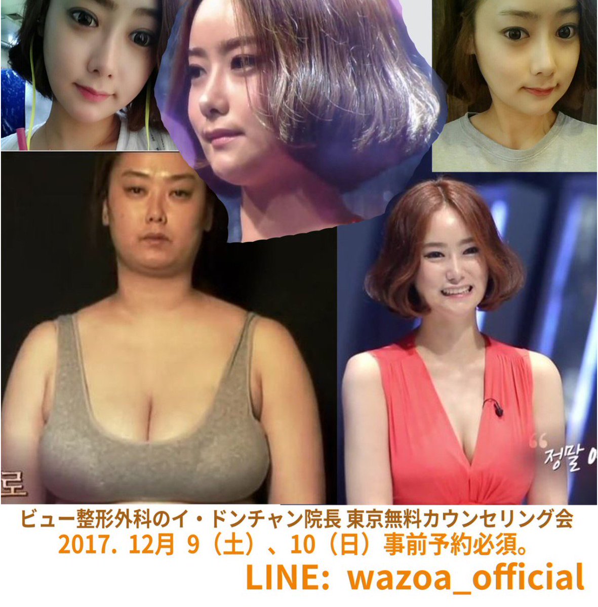 wazoaofficial's tweet image. 韓国の本物の名医
ビュー整形外科の イ・ドンチャン院長 東京無料カウンセリング会
2017.12. 9（土）、10（日）(事前予約必須)

詳しいご案内はこちら
ameblo.jp/wazoa/

#ビュー整形外科 #両顎 #輪郭 #twice #防弾少年団 
#韓国整形 #美容整形 #ミニV #Vライン #エラ