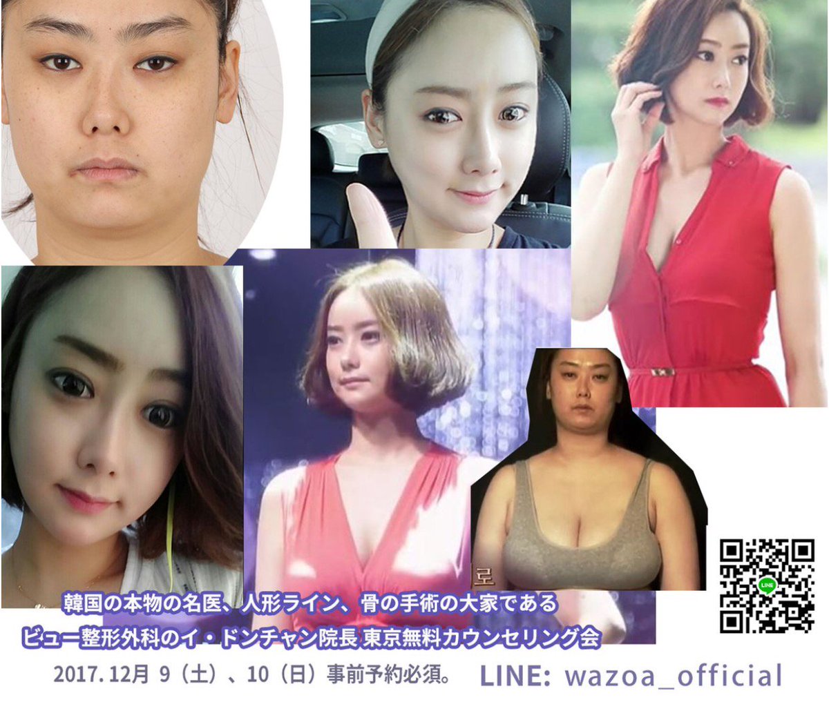 wazoaofficial's tweet image. 韓国の本物の名医
ビュー整形外科の イ・ドンチャン院長 東京無料カウンセリング会
2017.12. 9（土）、10（日）(事前予約必須)

詳しいご案内はこちら
ameblo.jp/wazoa/

#ビュー整形外科 #両顎 #輪郭 #twice #防弾少年団 
#韓国整形 #美容整形 #ミニV #Vライン #エラ