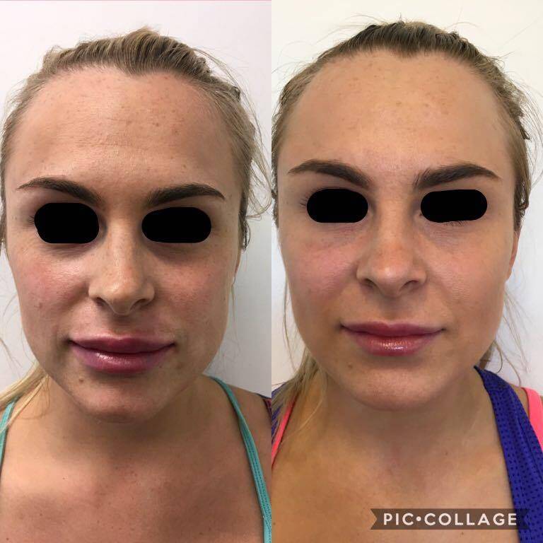 early crows feet eyes