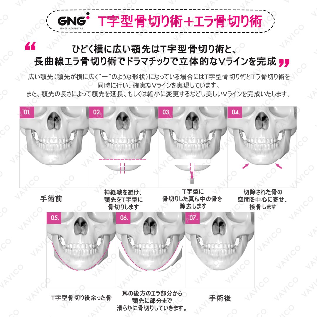vavicojapan's tweet photo. 綺麗なフェイスラインを手に入れたいならGNG美容整形外科👸🏻💗✨
#GNG美容整形外科 #vavico #バビコ #美容整形サポート #韓国 #美容整形 #輪郭手術 https://t.co/TN3CkEbVW8