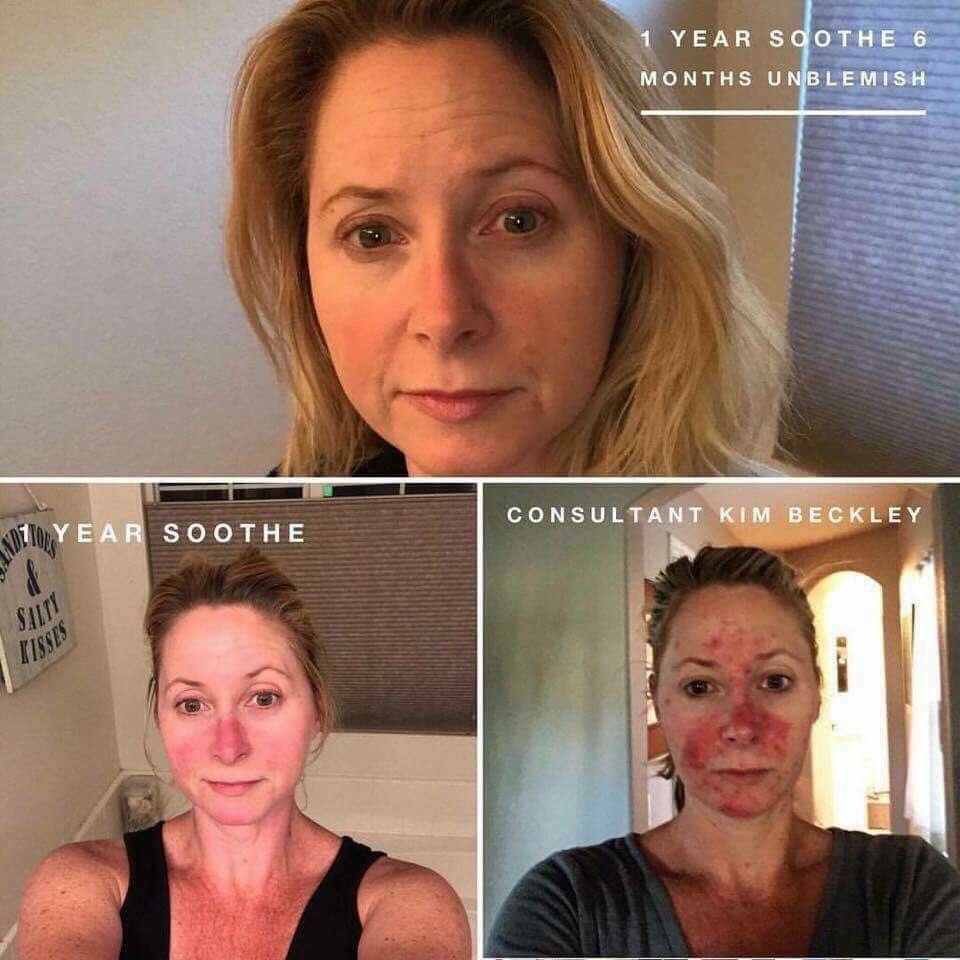 LawrieTash's tweet photo. Transformation Tuesday 😱!! WOW! WOW! WOW! 

#TransformationTuesday #confident #beautiful #soothe #skincare #realresults https://t.co/jLEOi9Z3dB