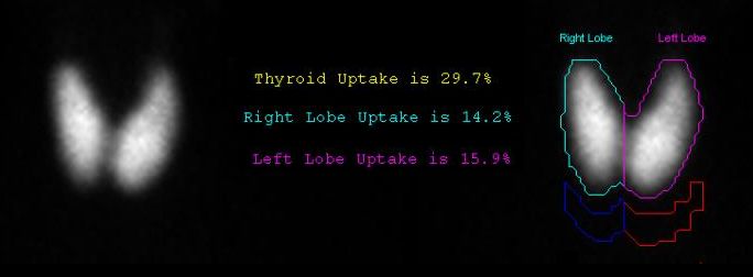 14/Nuclear medicine can also use radioactive isotopes to treat disease, such as hyperthyroidism and some cancers