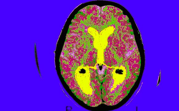 sciam's tweet photo. Here’s what we think Alzheimer’s does to the brain https://t.co/1Z1iPjUsXD https://t.co/77yQetbozs