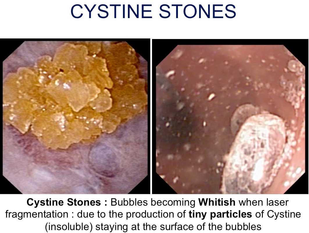 OTRAXER's tweet photo. T&amp;T34:To diagnose CystineStone Endoscopically?Yellow Shiny &amp;Compacted small crystals.Smell SULFURE: when Laser fragmentation&amp;Whitish Bubbles https://t.co/vYUEDlz19f