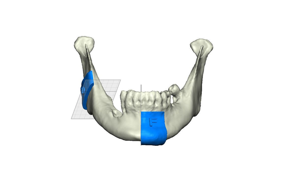AnatomikM's tweet photo. Contribution of 3D printing to mandibular reconstruction after cancer
https://t.co/4JRc2G8dIF
@Occitanie @URPS_Occitanie @ClaudiusRegaud https://t.co/PWeV3LMiZg