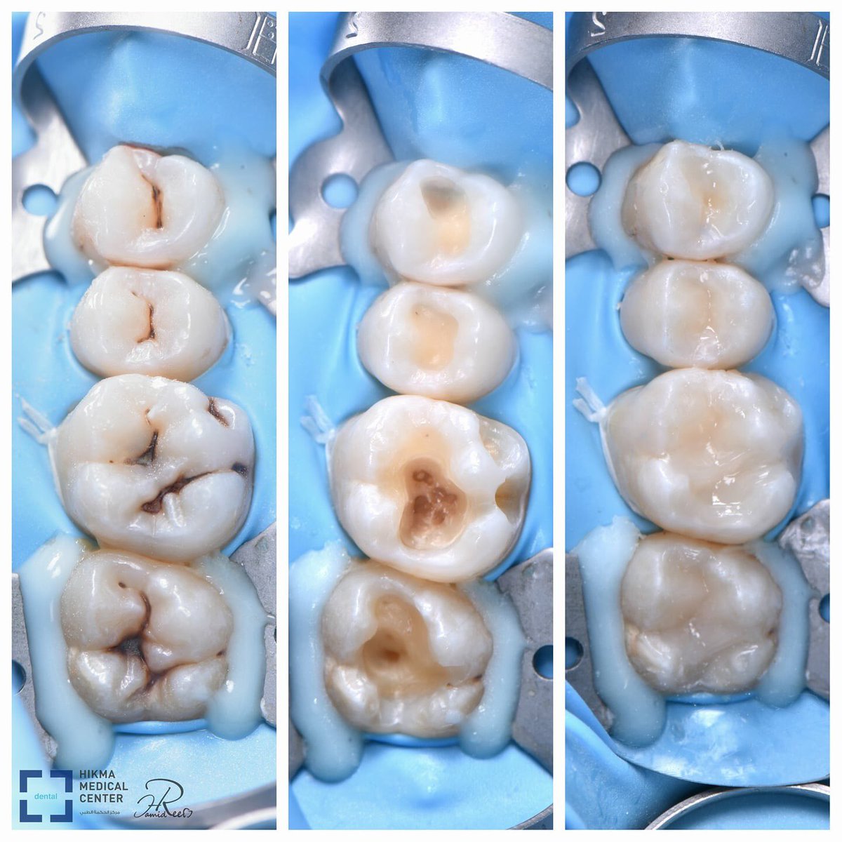 Dentagama's tweet photo. Fixing Tooth Decay with Composite White Fillings https://t.co/31oKOTI3z6