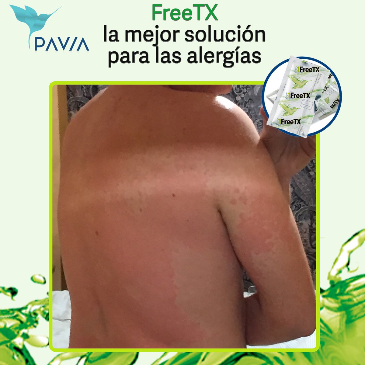 bugsracer's tweet photo. Hace unas semanas, al salir de la alberca noté unas ronchas en mi estomago provocadas por una alergia, empecé a tomar medicinas y a los 2 días todo mi cuerpo estaba lleno, así que cambié el tratamiento y empecé a consumir #FreeTX de @PaviaMx y la alergia desapareció #probioticos https://t.co/YenMMlh6H7
