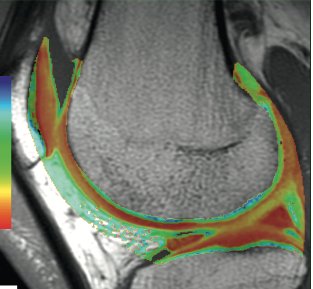 DavidStollerMD's tweet photo. CartiGram T2 mapping #TheKnee #StollerMSKcourse #Sagittal #Axial #MRI #Orthopaedics #SportsMedicine #T2Mapping #ImagingTechniques https://t.co/g2JCocEmmZ