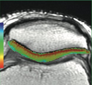 DavidStollerMD's tweet photo. CartiGram T2 mapping #TheKnee #StollerMSKcourse #Sagittal #Axial #MRI #Orthopaedics #SportsMedicine #T2Mapping #ImagingTechniques https://t.co/g2JCocEmmZ
