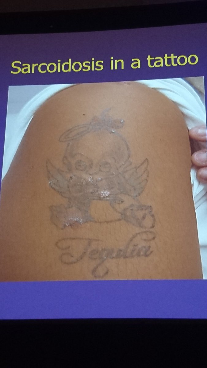 Granulomatous tattoo reaction in a young man  The Lancet