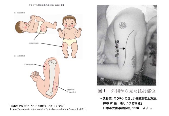 Mugen Ujiie 氏家 無限 A Twitter 正しい皮下接種の部位は 日本編 接種部位は上腕伸側の上1 3または下1 3が適切である 武谷茂 ワクチンの正しい接種部位と 方法 小児科臨床 49 639 649 1996 T Co Kiolsdi8yd