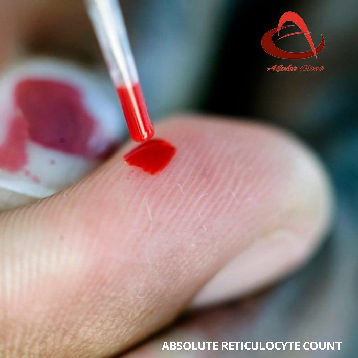 alphacarelab's tweet photo. 🔶🔶  Reticulocytes are inside the #blood for about 2 days before developing into mature purple #bloodcells.
#reticulocytecount #bloodstream #immaturecells #cancer #nucleus
🔺 Visit More@ https://t.co/iDFnPVgWZe
🔻 Book an Appointment 📲📲 9841537468 https://t.co/rnyURhcQMs