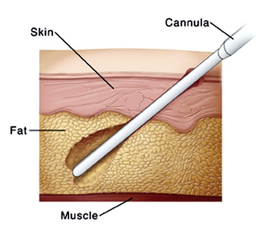 They all require the removal of the fat through the use of a Cannula