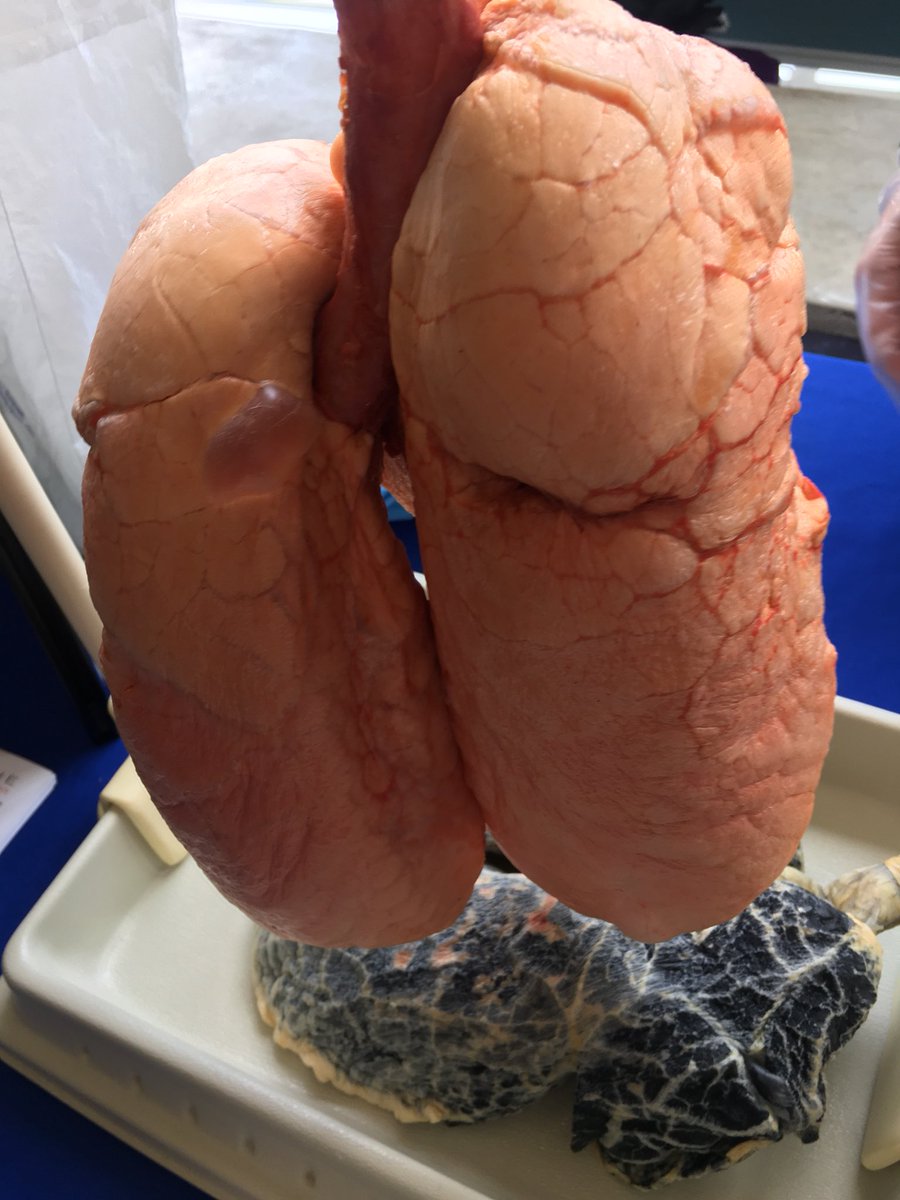 RocchinaAntunes's tweet image. #OSAID #Healthfair @SJDBrebeufCHS Healthy Lungs