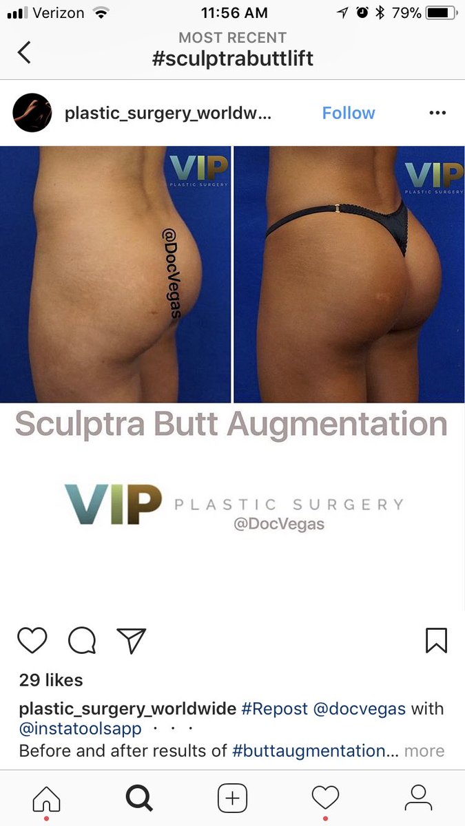 Sculptra is how Kylie Jenner did this. As y’all can see she clearly did not have much Fat to graft, to achieve her new hourglass figure.