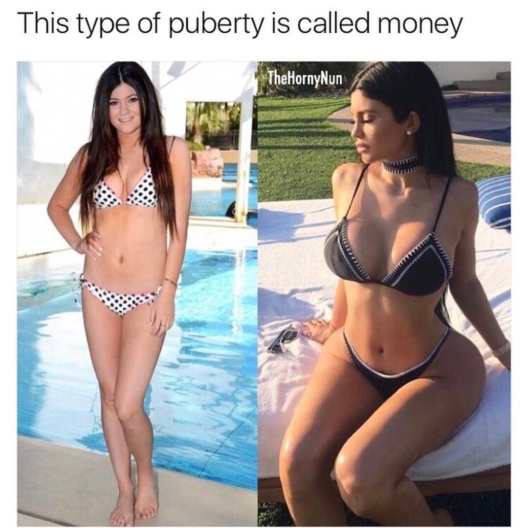 Sculptra is how Kylie Jenner did this. As y’all can see she clearly did not have much Fat to graft, to achieve her new hourglass figure.