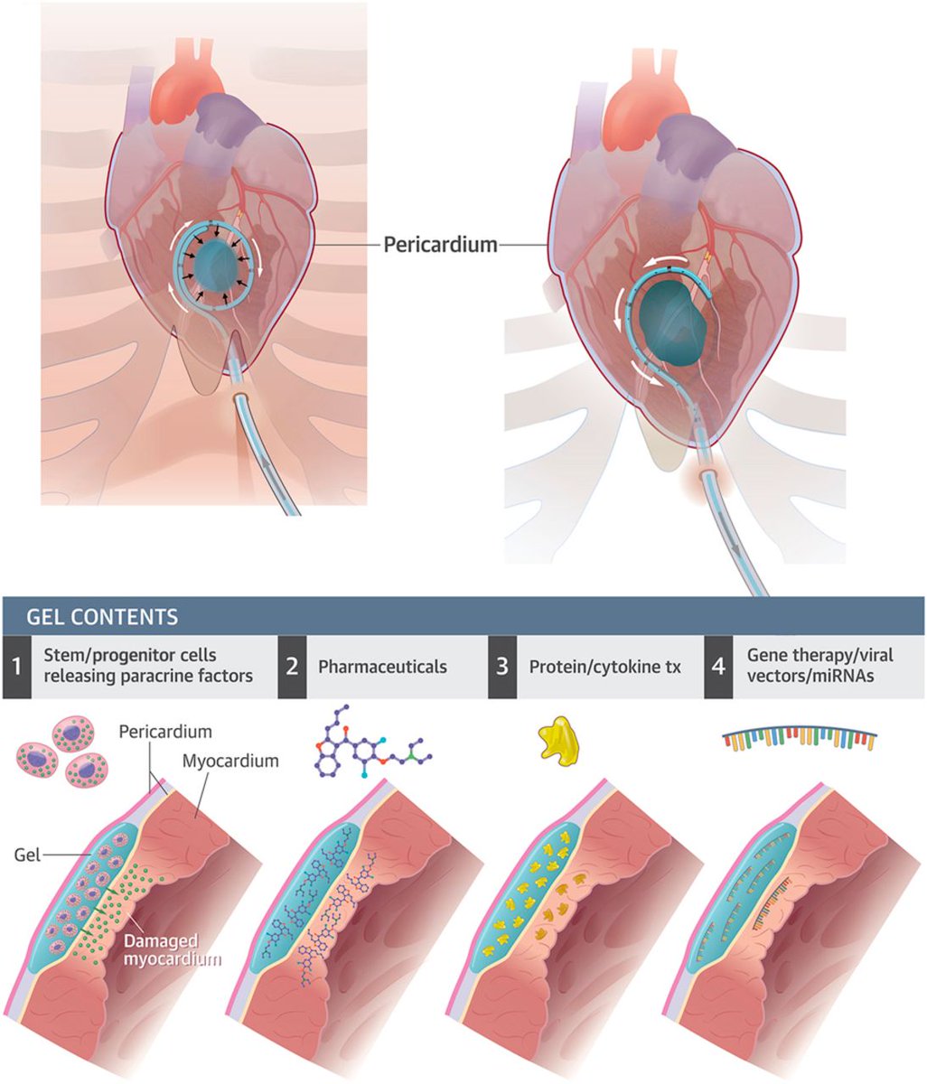 JACC Journals (@jaccjournals) on Twitter photo Can we deliver biomaterials to the heart through pericardial space? #JACCBTS #openaccess #research ow.ly/RTap30grNNu <a href="/EmoryMedicine/">Emory School of Medicine</a> Can we deliver biomaterials to the heart through pericardial space? #JACCBTS #openaccess #research ow.ly/RTap30grNNu <a href="/EmoryMedicine/">Emory School of Medicine</a>