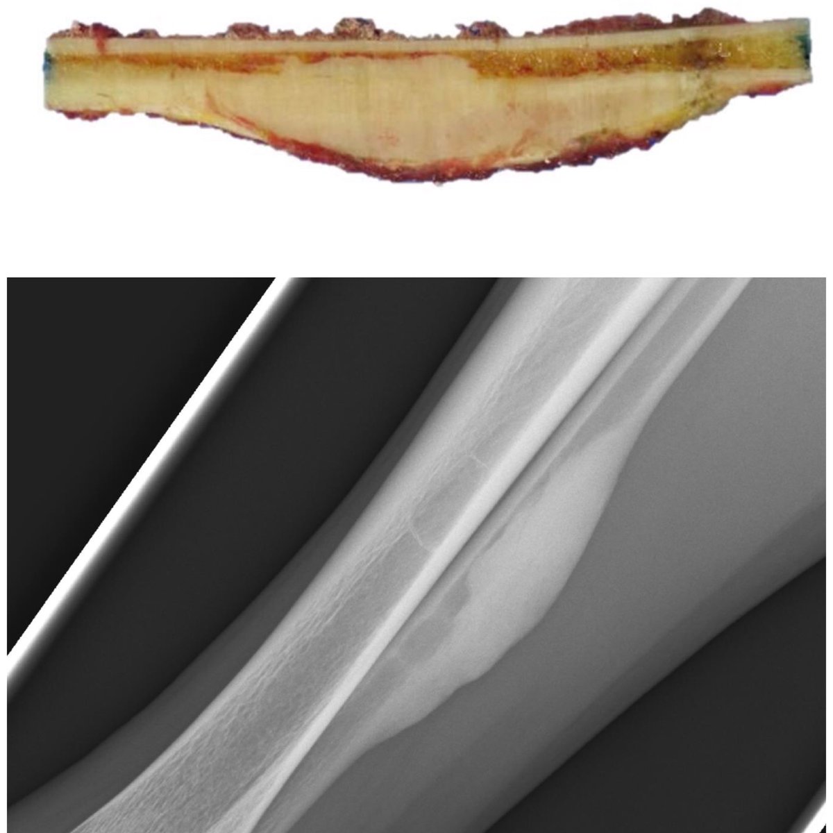 BoSTT_app's tweet photo. Case 71 live! #bone #pathology #radiology #mskradiol #bonepath @bosttapp https://t.co/JsT7jTfYo2