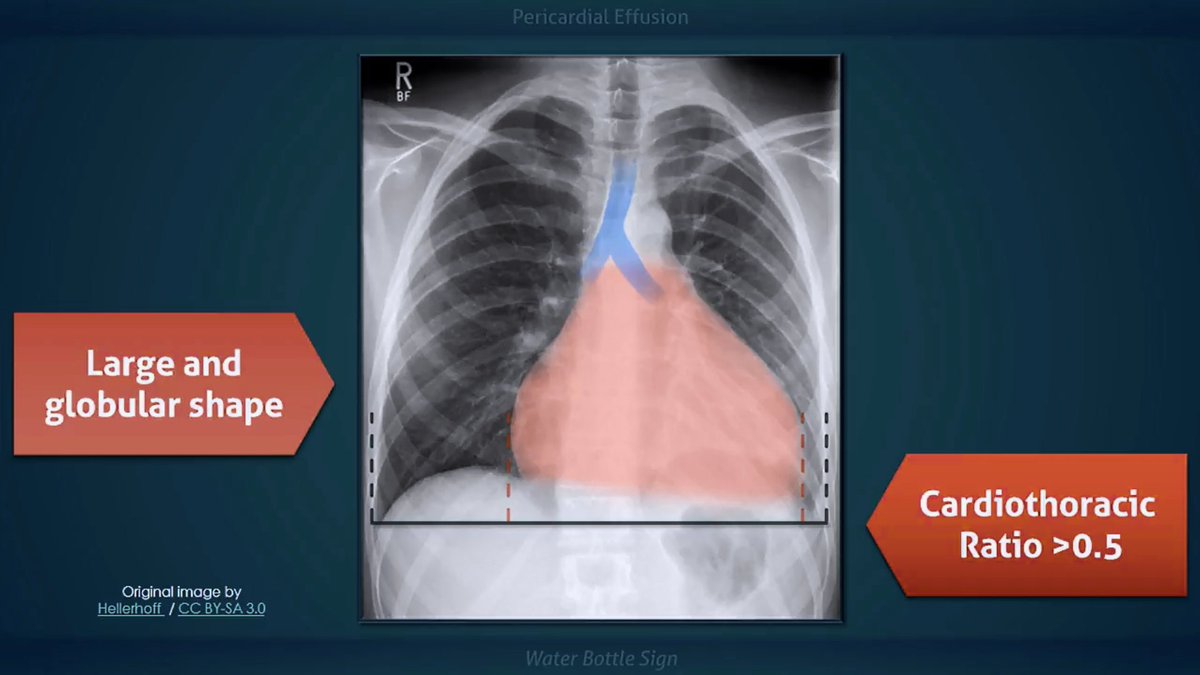 SEMDocs's tweet photo. Pericardial Effusion

Water Bottle Heart Sign - Note fluid in the pericardial space #medbullets More at: 
https://t.co/d4Kxlr1NXy
https://t.co/YsCYUIDufk https://t.co/1LD0N3HG7d