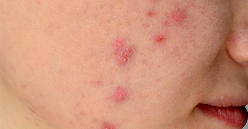 Theralight's tweet image. There's nothing more miserable than going through holiday parties with bad skin! Eliminate your chances now with &amp;gt;&amp;gt; amzn.to/2Aso3iA