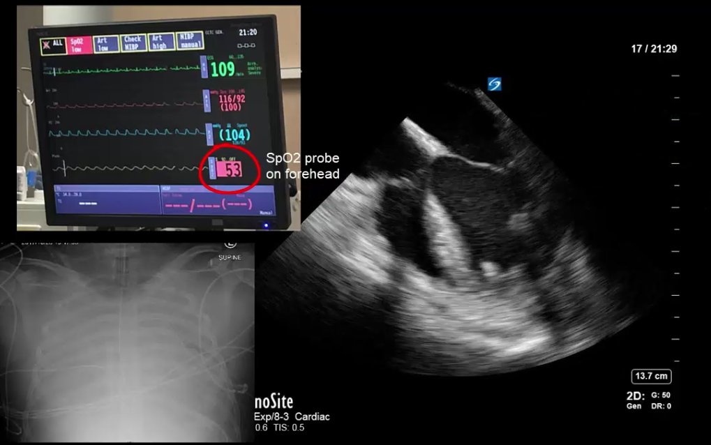 #POCUS Transesophageal echo:  Illustration of impact in a complex ECMO case. 
westernsono.ca/2017/11/08/tee…
 #harlequin
