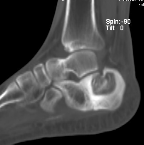 CursoMSKMexico's tweet photo. #IntraosseousLipomaCalcaneus associated with #PathologicFracture. #cursomskmexico #mskrad https://t.co/4suxXbZsXM