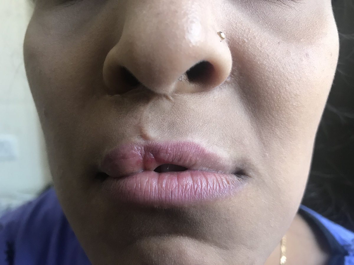 AndeiSoI's tweet photo. The STITCH SONG
A stitch in time saves nine
if stitched the right way
Or else, it could be ninty nine
If done the wrong way
Planning #liprevision or #redosurgery for this pretty girl.
#plasticsurgery #plasticsurgeon https://t.co/pdnTxaC8HI