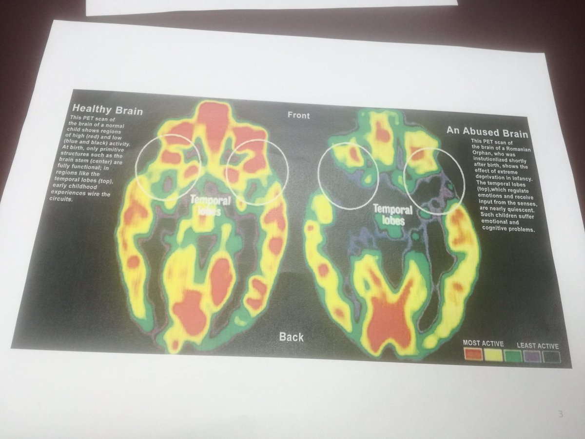NORDA1's tweet photo. Difference between a normal brain and an abused brain is seen below. Parents must be taught early stimulation in first 1000 days. @ECCJA https://t.co/lAlvXbaakv