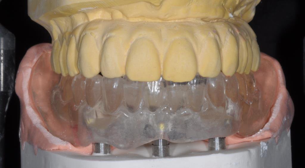 TBDentalLab's tweet photo. Trevor Brooker &amp; Andrew Dawood collaborate on the first UK case using the new exciting Trefoil implant system from Nobel Biocare #andrewdawood #dawoodandtanner #nobelbiocare #TrevorBrookerLab #dentalimplants https://t.co/dI1wQEBtBK