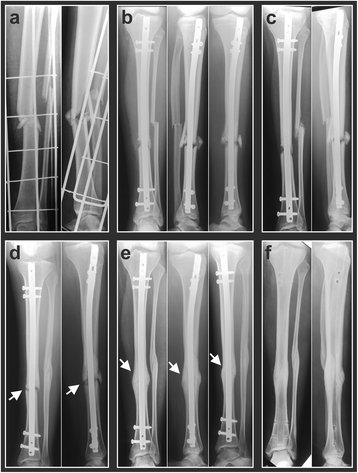 MSKmedBMC's tweet photo. Radial extracorporeal shock wave therapy for treatment of #fracture nonunions of superficial bones https://t.co/pYnLU5XqOb #JOSR #ShockwaveTherapy https://t.co/sQ0jfSGCCN