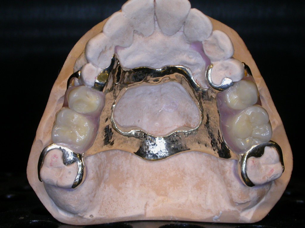 TBDentalLab's tweet photo. Gold Denture (RPD) prepared for patient with expensive taste! #TrevorBrookerLab #Golddenture #RPD #Gold #Prosthetics https://t.co/I5AtYJRF6v