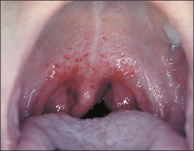 DYK?: Streptococcal throat infections in kids can increase risk for mental health disorders and #OCD ja.ma/2jbGMuA #PANDAS #strep