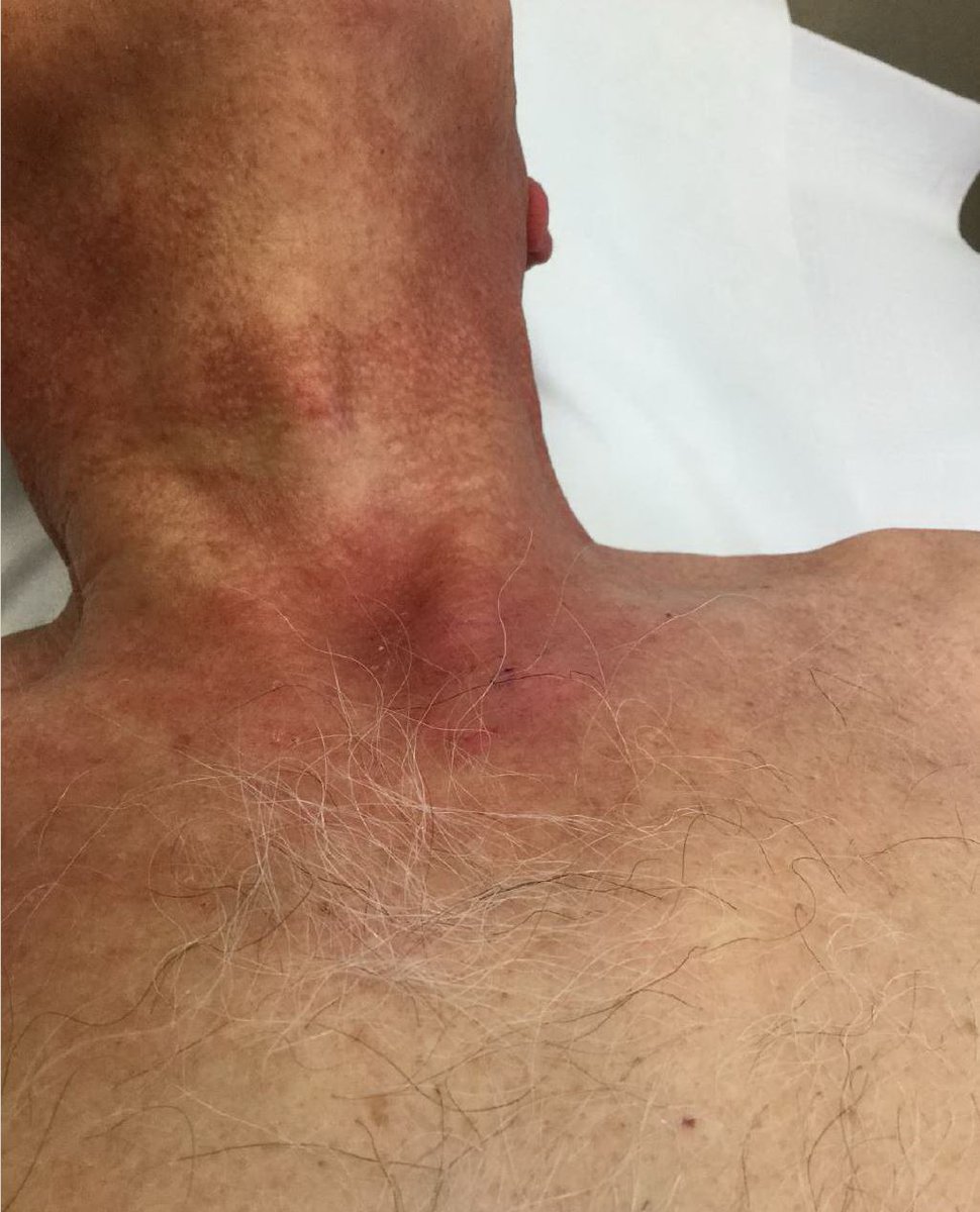 DrZembowicz's tweet image. Histological findings in dermatomyositis are rather non-specific. Interface changes and dermal mucin seem most consistent. #dermpath #pathology