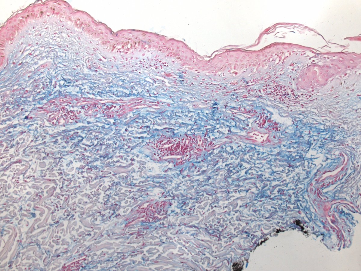 DrZembowicz's tweet image. Histological findings in dermatomyositis are rather non-specific. Interface changes and dermal mucin seem most consistent. #dermpath #pathology