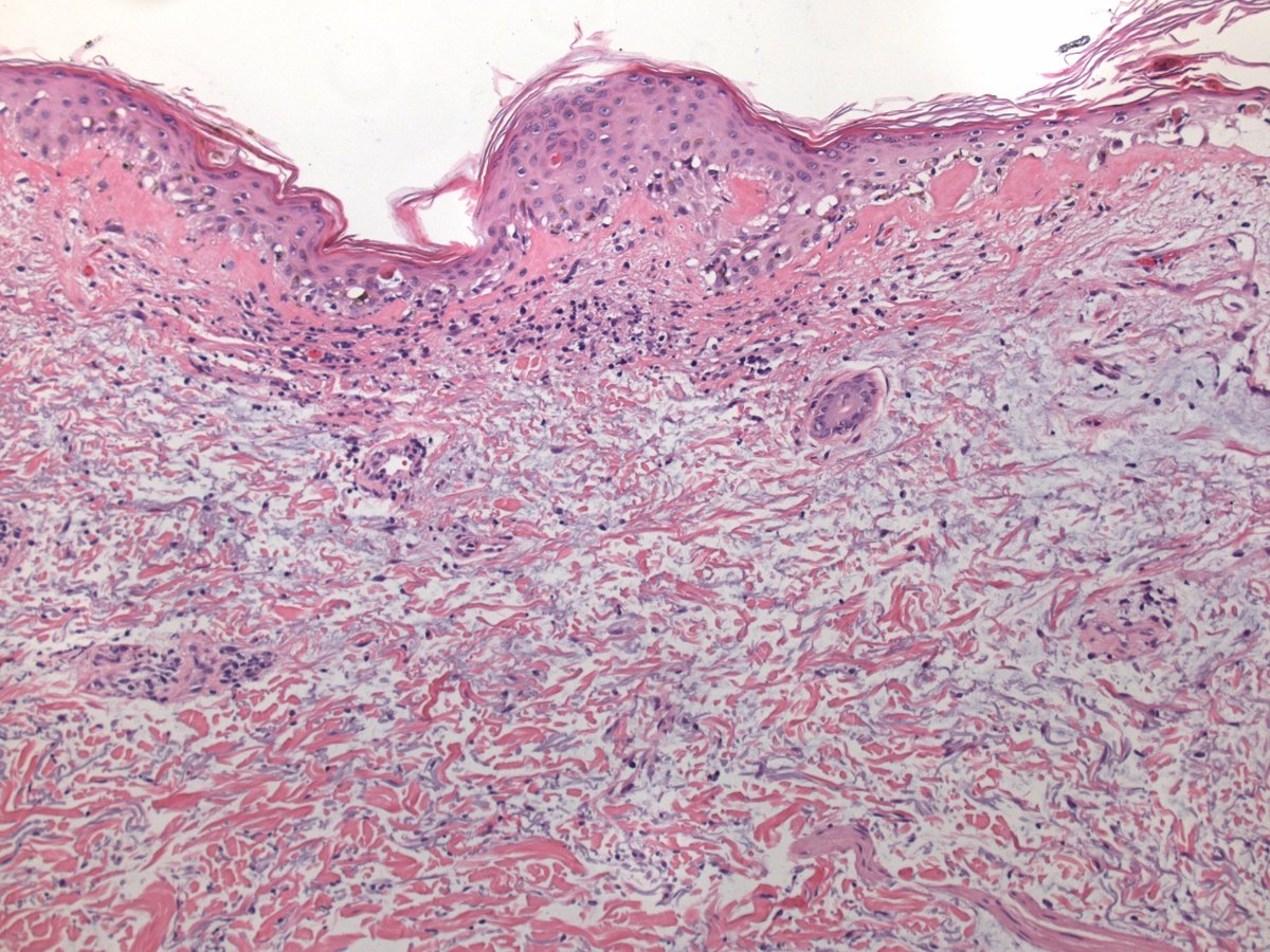 DrZembowicz's tweet image. Histological findings in dermatomyositis are rather non-specific. Interface changes and dermal mucin seem most consistent. #dermpath #pathology