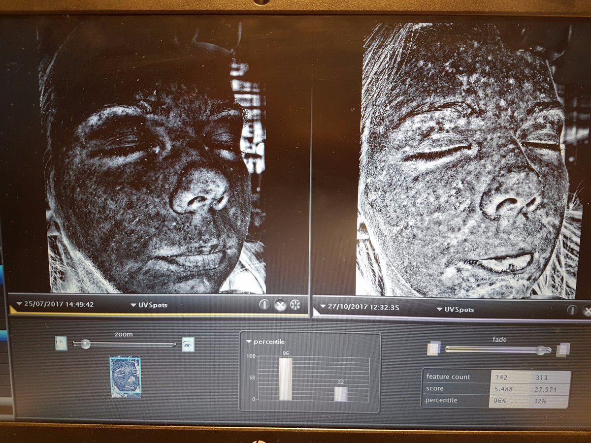 SianVictoriaUK's tweet photo. Sneak peek at my final #100dayreset results @iiaaLtd! So pleased with my skins journey, using @EnvironUK Sebuwash &amp; AVST Moisturiser 1, @UK_ANP Skin Accumax supplements &amp; @janeiredale_UK makeup! Photo shows sun damage before &amp; after! #beauty #skincare #bbloggers #beautyblogger https://t.co/LEcmIIrlf3