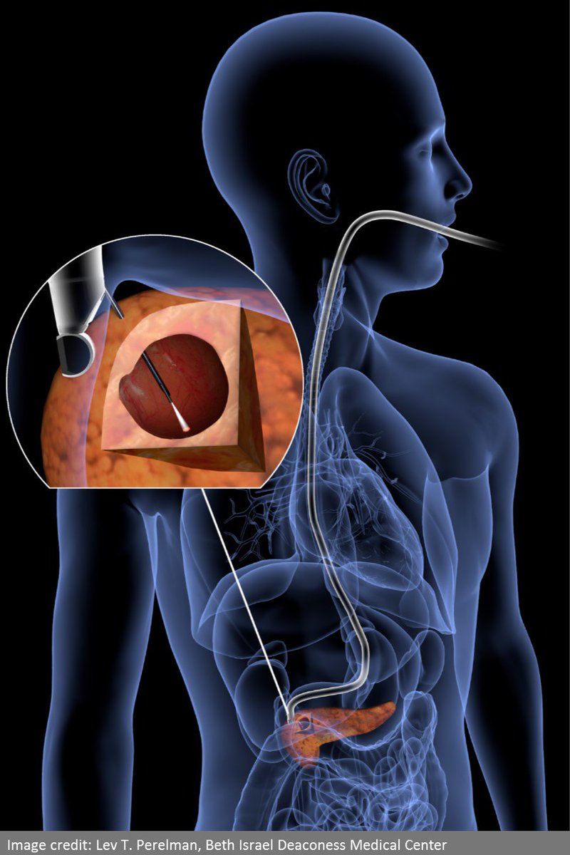 NSF's tweet photo. #NSFfunded researchers developed a light scattering tool that can identify pancreatic cancer. https://t.co/4gvzxDA1b3 https://t.co/Aio65lT8bE