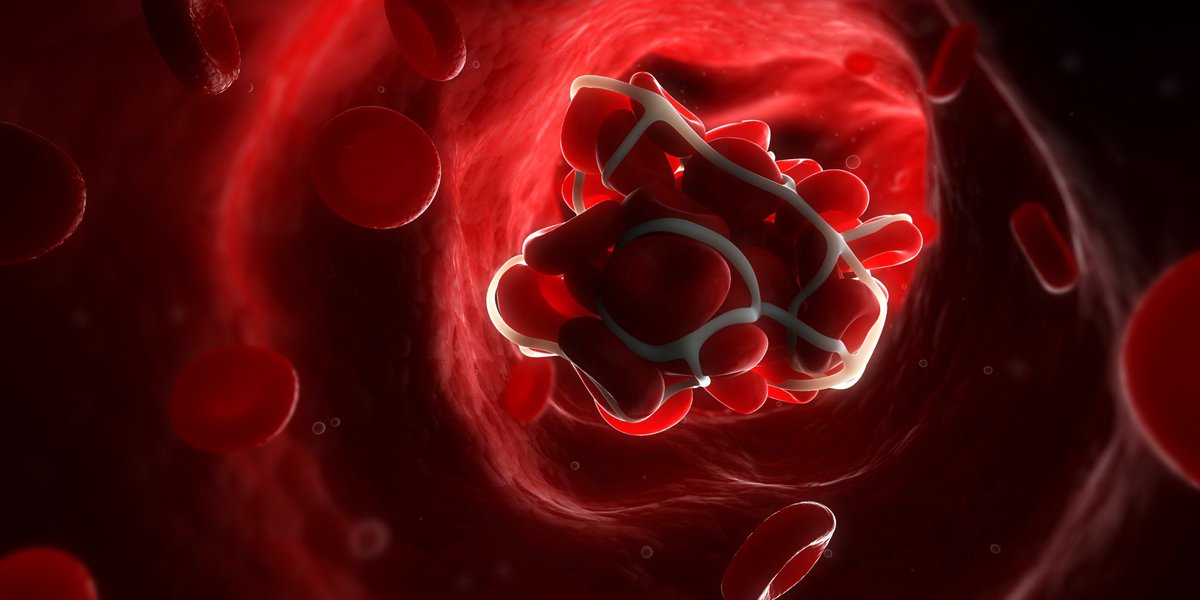 Vascular_centr's tweet photo. What are the Symptoms of a Blood Clot? https://t.co/9oJ3CLtHDb https://t.co/uoXExmV3cZ