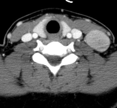 The_ASPNR's tweet image. Classic Pediatric H&amp;amp;N case. Teenager with left neck mass. DX?