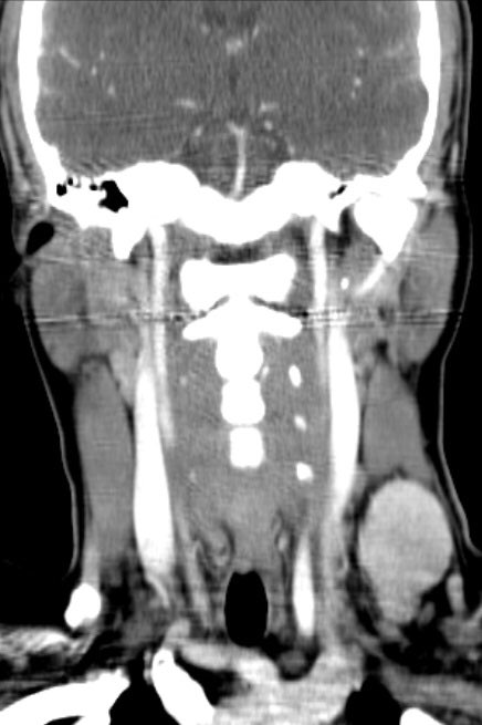 The_ASPNR's tweet image. Classic Pediatric H&amp;amp;N case. Teenager with left neck mass. DX?