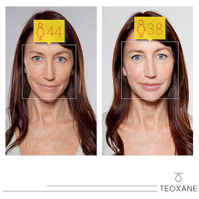 TeoxaneLebanon's tweet photo. Take a look at Louise’s Teosyal® Ultra Deep “Before &amp; After” pictures. She looks like 6 years younger! Wanna try?

#Teosyal #UltraDeep #BeforeAfter #Antiage #Beauty #SkinCare
#Luxury #GannagePharma #Swiss #Glow #Glam #Trendy #Cosmetic #TeosyalUltraDeep https://t.co/86JRa0FEry