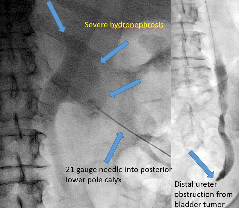 ABrandisMD's tweet photo. 76 year old man with large bladder tumor causing obstructive right uropathy. Failed Urology retrograde ureteral stent placement...#CallIR Successful PCNU placement for decompression. #iRad #MediocreAnnotations https://t.co/Ho3HAD8AqH