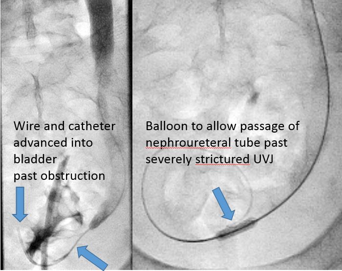 ABrandisMD's tweet photo. 76 year old man with large bladder tumor causing obstructive right uropathy. Failed Urology retrograde ureteral stent placement...#CallIR Successful PCNU placement for decompression. #iRad #MediocreAnnotations https://t.co/Ho3HAD8AqH