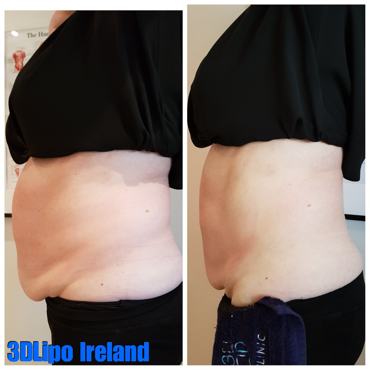 3D_LipoIRL's tweet photo. Incredible result today in our @3direland Flagship clinic.
Radio frequency & Cavitation ONLY full treatment 90 minutes ONLY...
#unbelievable #body #fat #fatreduction #radiofrequency #3dcavitation #shaping #results #clinic #salon #spa #3dultimate #powerof3d #topmachine https://t.co/EJCq7lNSIM