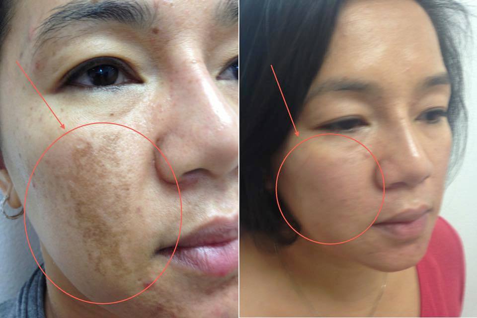 skinmedequip's tweet photo. Do you know why Lasers are effective for Treating Melasma? Read more about it here: https://t.co/T3MgljRmDm #skinmedicalequipment #skintightening #scartreatment #antiaging https://t.co/32fbac2cfY
