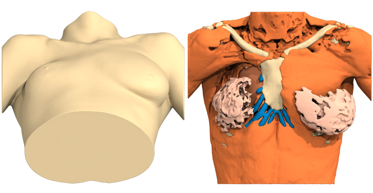 AnatomikM's tweet photo. Poland Syndrome case of the week.
Woman, right side totally affected.
3D virtual patient's body reconstruction from #CTscan datas to design #3D custom-made #implant.
#PolandSyndrome #BreastAsymmetry #medical https://t.co/YPFSL5eHWc