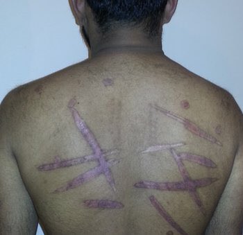 amalab's tweet photo. @itjpsl @UNHumanRights @paisleydodds @AP Wonder how many Doctors,Psychologists,Lawmakers,#HumanRights Grps & so-called Journos have been easily duped by some @SriLanka Tamils using ‘Self-Inflicted By Proxy’ Torture to seek UK Asylum?@jameykeaten @katydaigle @MsKateLyons @zoelouisedrew #lka #SIBP https://t.co/YQhKcQagUB https://t.co/xRvgDFkrdA